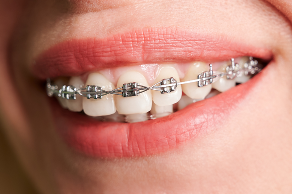 الفرق بين تقويم الاسنان المعدني والشفاف..<br>وما هي أنواع تقويم الأسنان  المعدني - ابتسامة جميلة