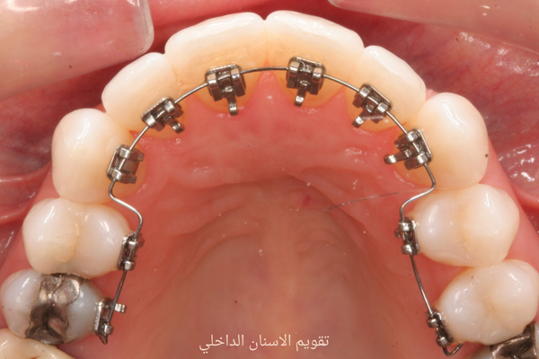 تقويم الأسنان الداخلي الدائم | تعرف على اهم 9 أضرار لتقويم الأسنان الداخلي  الدائم