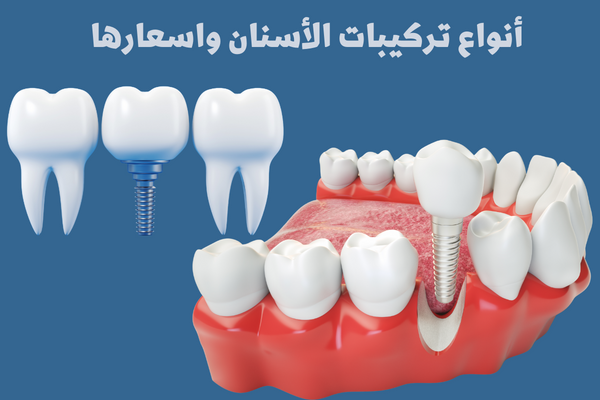 أنواع تركيبات الأسنان واسعارها