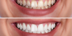 اسنان قبل وبعد التقويم.. ومتى تظهر نتائج تقويم الاسنان؟