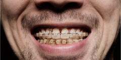 الوان التقويم الاسنان للرجال | تعرف على افضل الوان التقويم الاسنان للرجال