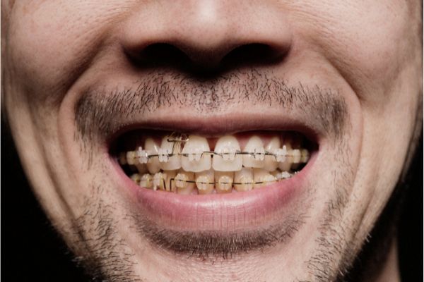 الوان التقويم الاسنان للرجال