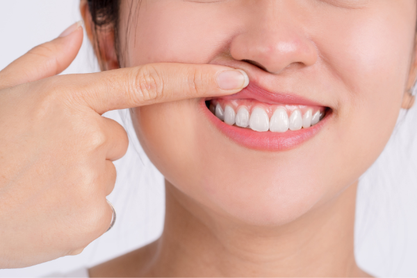 علاج بروز الأسنان الأمامية بدون تقويم