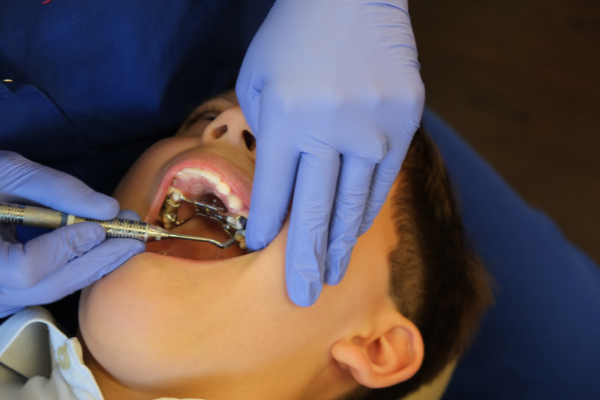 ما هى خطوات تركيب تقويم الاسنان