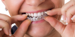 هل التقويم الشفاف يعالج بروز الأسنان؟ وما هي مدة لبس التقويم الشفاف؟