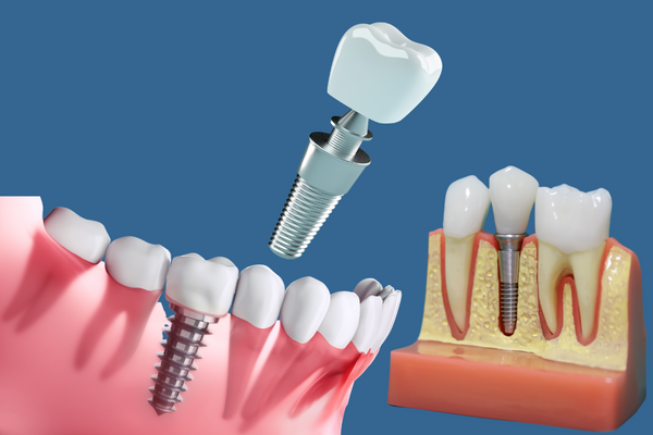 Najlepšie typy fixných zubných náhrad Aké sú škody fixných zubných implantátov? - krásny úsmev