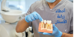 أخطاء زراعة الأسنان.. وما هي أعراض فشل زراعة الأسنان؟