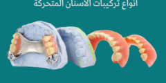 أنواع تركيبات الأسنان المتحركة | وما هي أضرار تركيبات الأسنان المتحركة؟