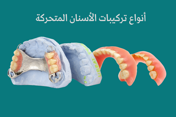 أنواع تركيبات الأسنان المتحركة