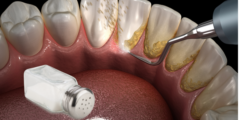 إزالة جير الأسنان بالملح.. وكيفية إزالة الجير من الأسنان بطرق طبيعية