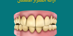 ازالة اصفرار الاسنان | تعرف على طريقة ازالة اصفرار الاسنان نهائياً