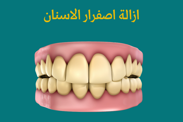 ازالة اصفرار الاسنان