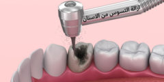ازالة التسوس من الاسنان.. وما هي مراحل تسوس الأسنان؟