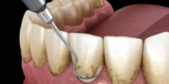 ازالة الكلس من الاسنان | تعرف على افضل طريقة لإزالة الكلس من الاسنان