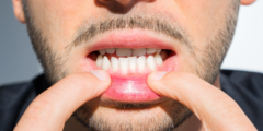 اسباب تركيب التقويم | تعرف على أهمية تركيب تقويم الاسنان