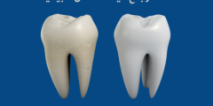 استرجاع مينا الأسنان طبيعيا | وما هي اعراض تاكل مينا الاسنان؟