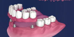 اسنان تركيب مؤقت | تعرف على طريقة تركيب الاسنان المؤقت بالتفصيل