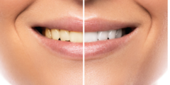 اصفرار الأسنان بعد التقويم | تعرف على كيفية علاج اصفرار الاسنان بعد التقويم
