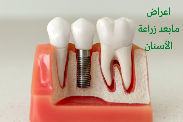اعراض مابعد زراعة الأسنان
