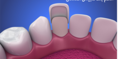 الندم بعد تلبيس الأسنان | ما هي عيوب تلبيس الأسنان؟