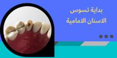 بداية تسوس الاسنان الامامية | تعرف على كيفية علاج بداية التسوس
