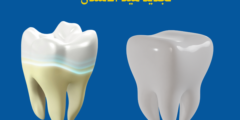 تجديد مينا الأسنان | تعرف على كيفية علاج تآكل مينا الأسنان
