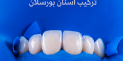 تركيب اسنان بورسلان | تعرف على مزايا تركيبات الأسنان البورسلان