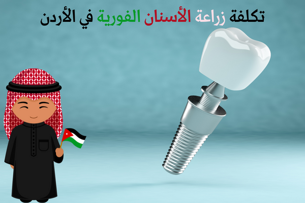تكلفة زراعة الأسنان الفورية في الأردن