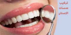 طريقة تركيب عدسات الاسنان للحصول على ابتسامة ناصعة البياض