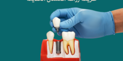 طريقة زراعة الاسنان الحديثة.. وكيف تتم عملية زرع الاسنان؟