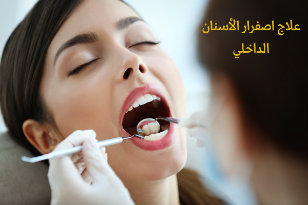 علاج اصفرار الأسنان الداخلي