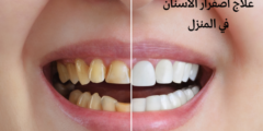 علاج اصفرار الأسنان في المنزل | وما هي أسباب اصفرار الأسنان؟