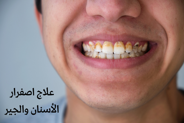 علاج اصفرار الأسنان والجير