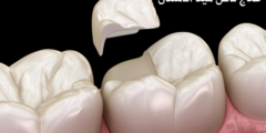 علاج تآكل مينا الأسنان | وما هي مضاعفات تآكل مينا الأسنان؟