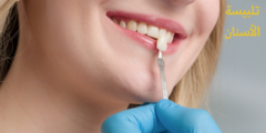 غراء تلبيسة الأسنان | وما هي اسباب سقوط تلبيسة الأسنان؟