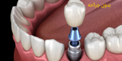 كيفية زراعة الاسنان بدون جراحه؟ | تعرف على مزايا زراعة الأسنان بدون جراحة