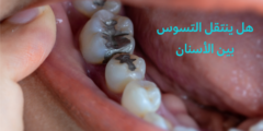 هل ينتقل التسوس بين الأسنان؟.. وما هي مراحل تسوس الاسنان؟