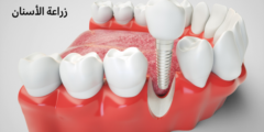 أعراض فشل زراعة الأسنان.. وما هي اسباب فشل زراعة الاسنان؟