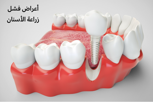 أعراض فشل زراعة الأسنان
