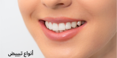 أنواع تبييض الأسنان واسعارها | وما هي أسباب اصفرار الأسنان؟