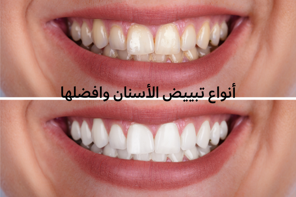 أنواع تبييض الأسنان وافضلها