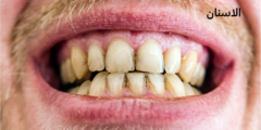 اسباب اصفرار الاسنان | تعرف على كيفية علاج صفار الأسنان