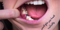 المدة بين خلع السن والتركيب | كم تستغرق مدة تركيب الاسنان؟