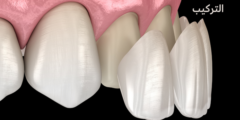 انواع الاسنان التركيب | تعرف على أفضل انواع الاسنان التركيب واسعارها