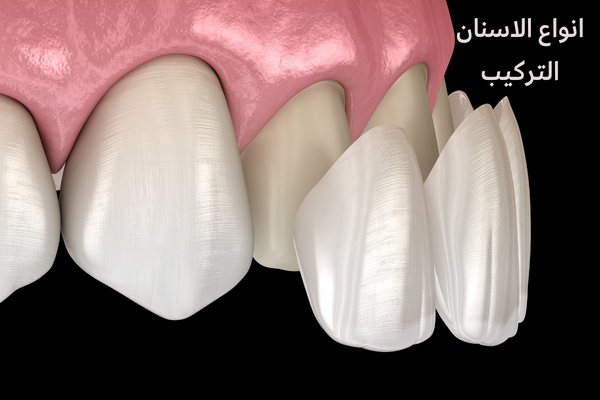 انواع الاسنان التركيب