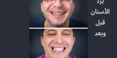 برد الأسنان قبل وبعد | تعرف على طريقة برد الاسنان بالتفصيل