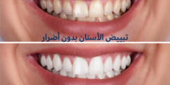 تبييض الأسنان بدون أضرار | متى تظهر نتائج تبييض الاسنان؟