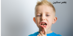 تسوس أسنان الأطفال بعمر سنتين | وما هي أسباب تسوس أسنان الأطفال بعمر السنتين