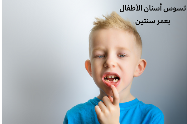 تسوس أسنان الأطفال بعمر سنتين