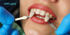 تلبيس الاسنان بدون نحت.. وما هي طرق تجميل الاسنان بدون نحت؟
